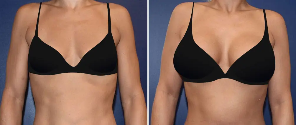 Mandell-Brown Plastic Surgery Breast Augmentation Before and After Patient Results