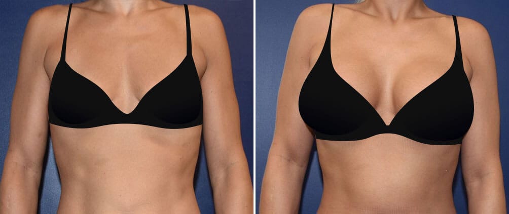 Before and after A cup to DD cup breast implants