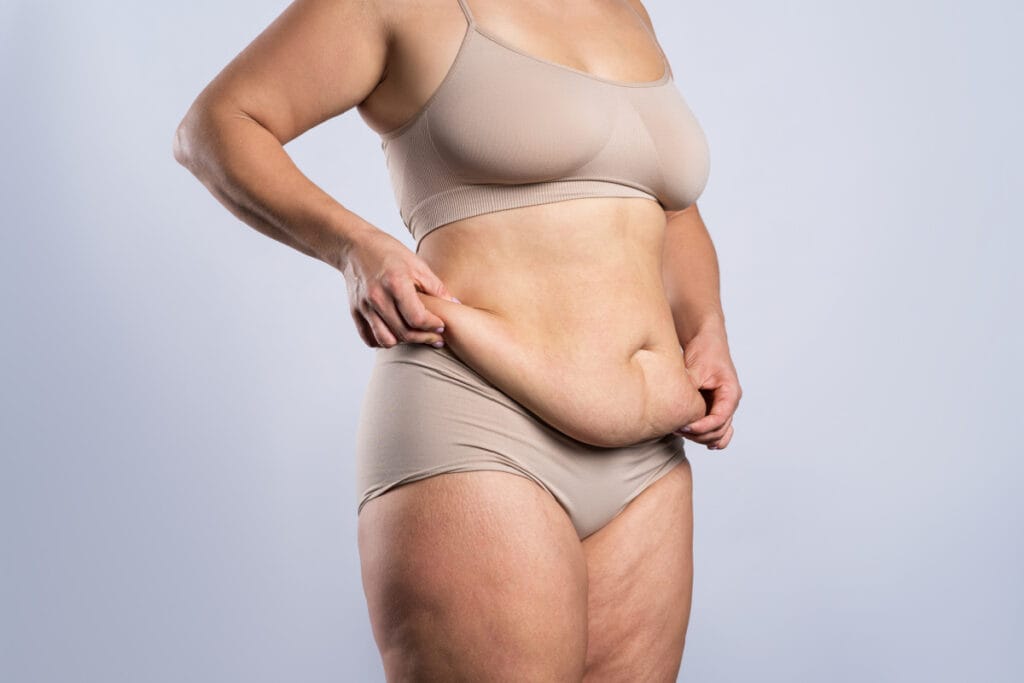 Woman with excess sagging skin after weight loss