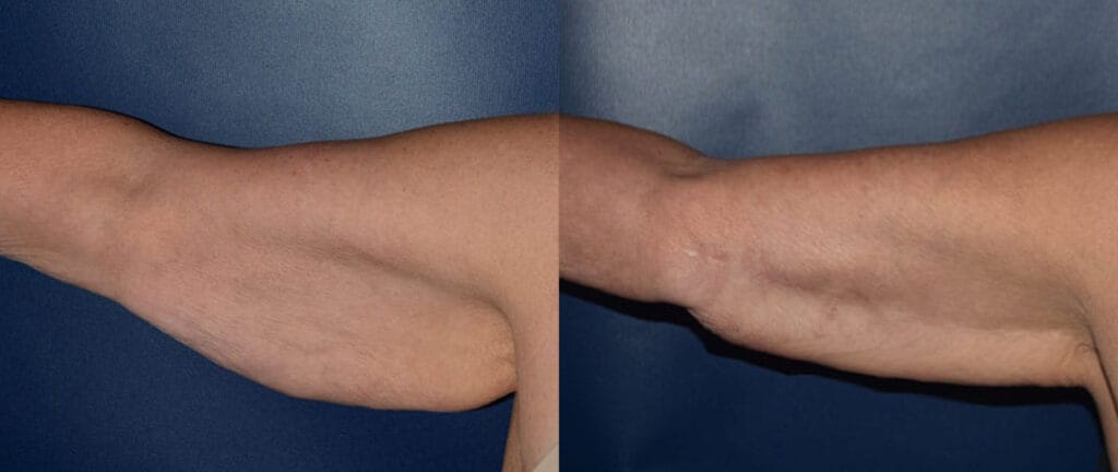 Before after Cincinnati arm lift with Dr. Mandell Brown
