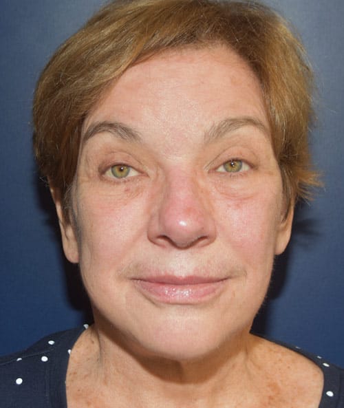 Deep Plane Facelift