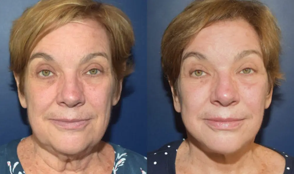 Deep Plane Facelift before and after surgery results with Dr. Mark Mandell-Brown