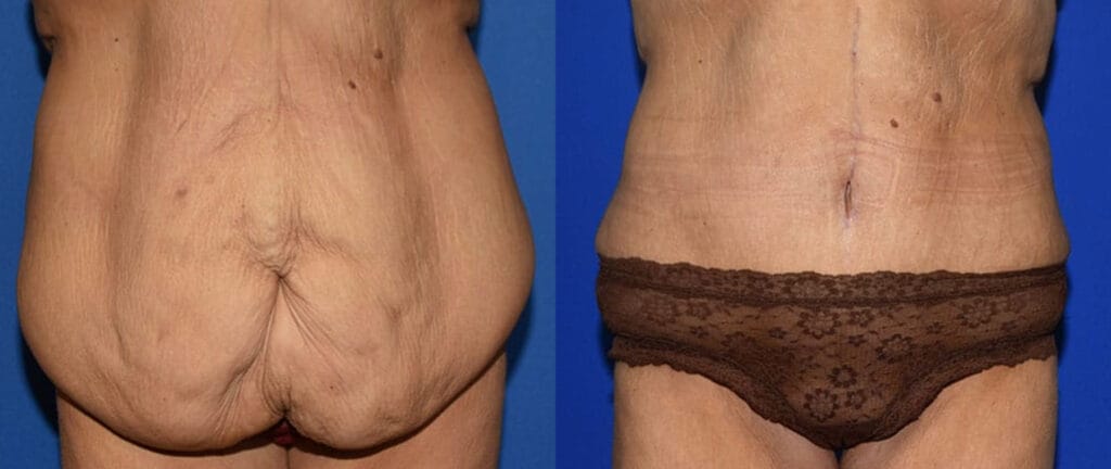 Before and after a fleur-de-lis tummy tuck in Cincinnati with Dr. Mandell-Brown